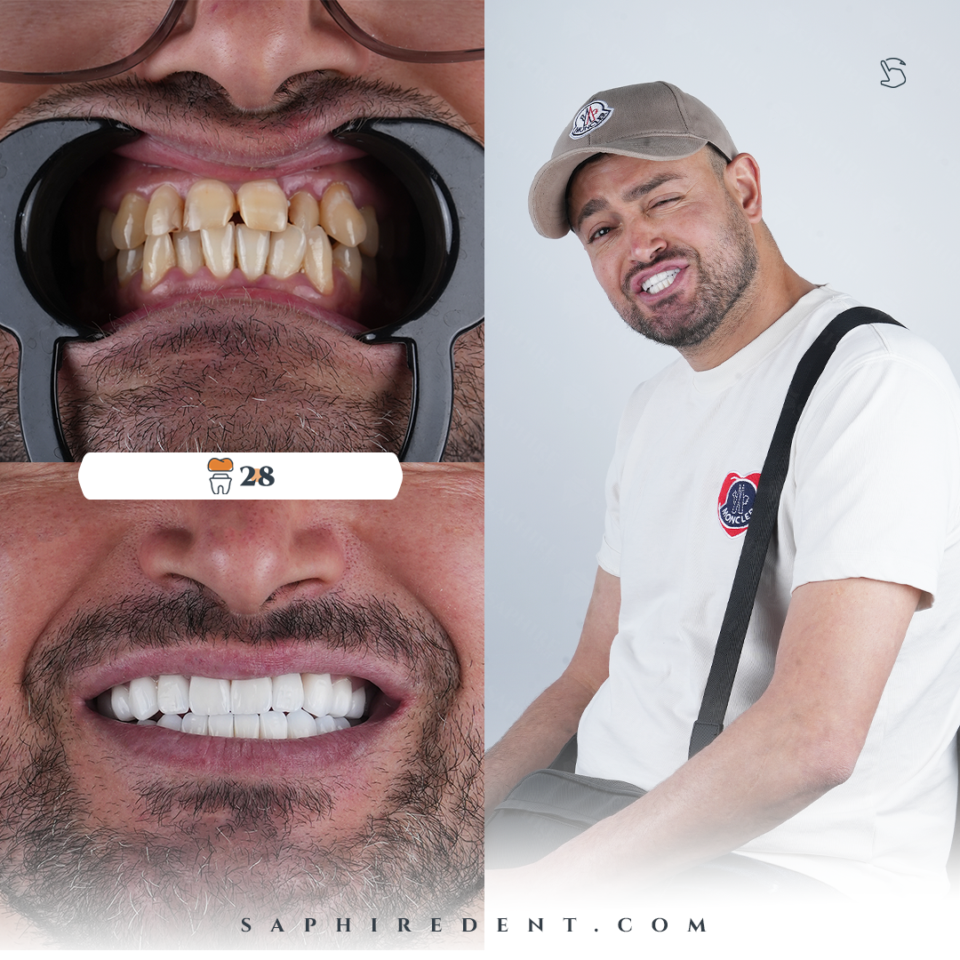 Dental Crowns